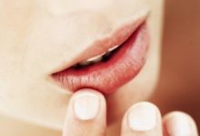 Что делать если обветрились губы: выясняем причину и подбираем лечение